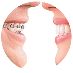 apparecchio denti trasparente